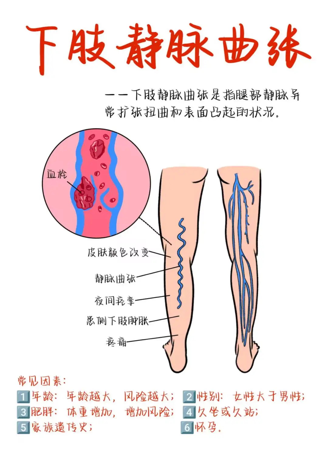 医学生笔记——下肢静脉曲张