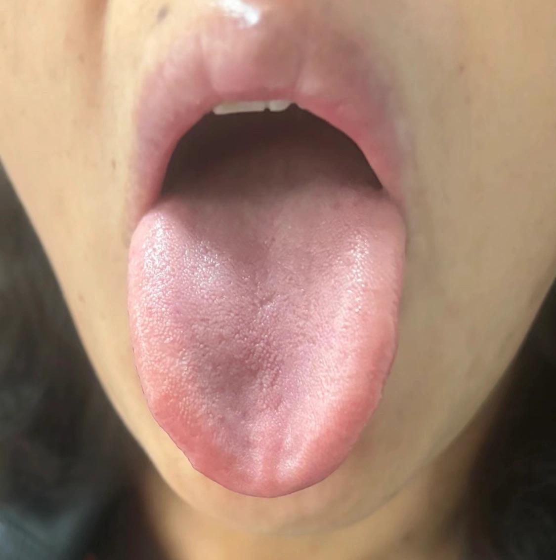 喜大普奔，他的脾虚好了！！!
患者曾经是：面色萎黄，身体沉重，容易疲劳，总感觉喉