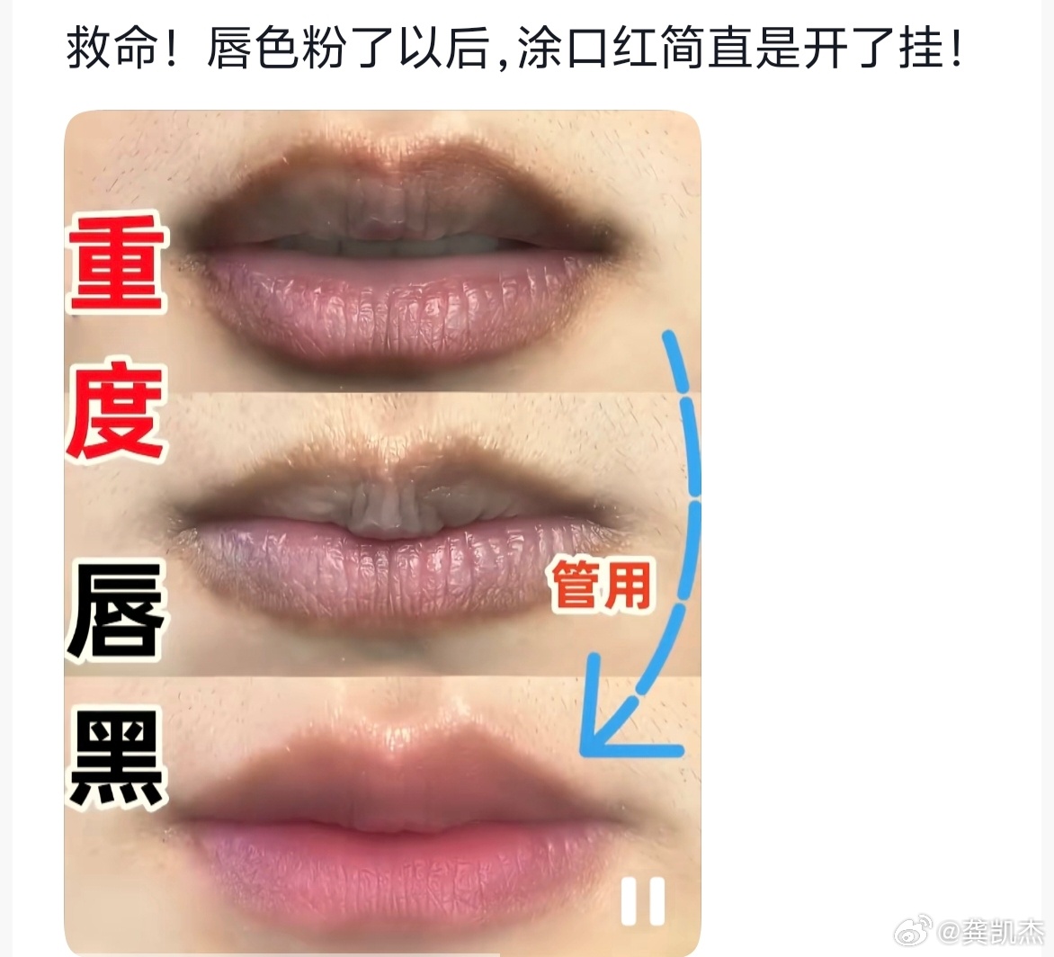 医生称嘴唇发紫未必就是心脏不好嘴唇发黑可能是生理性原因。1，生理性原因：长期吸烟