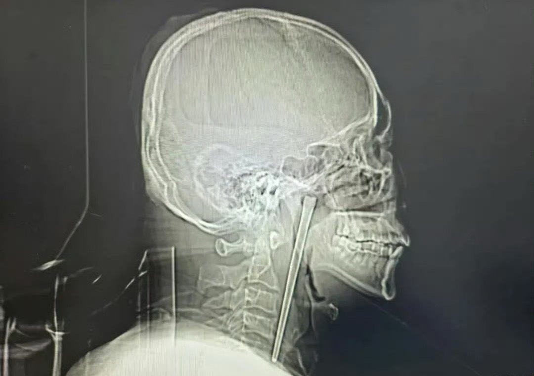 男子误吞12厘米筷子忍了8年才取出这，12厘米的金属筷子吞进肚子里就够吓人了，居