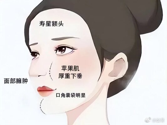 馒化脸是什么“馒化脸”是面部过度填充综合征的俗称，指面部像发面馒头般肿胀、僵硬、
