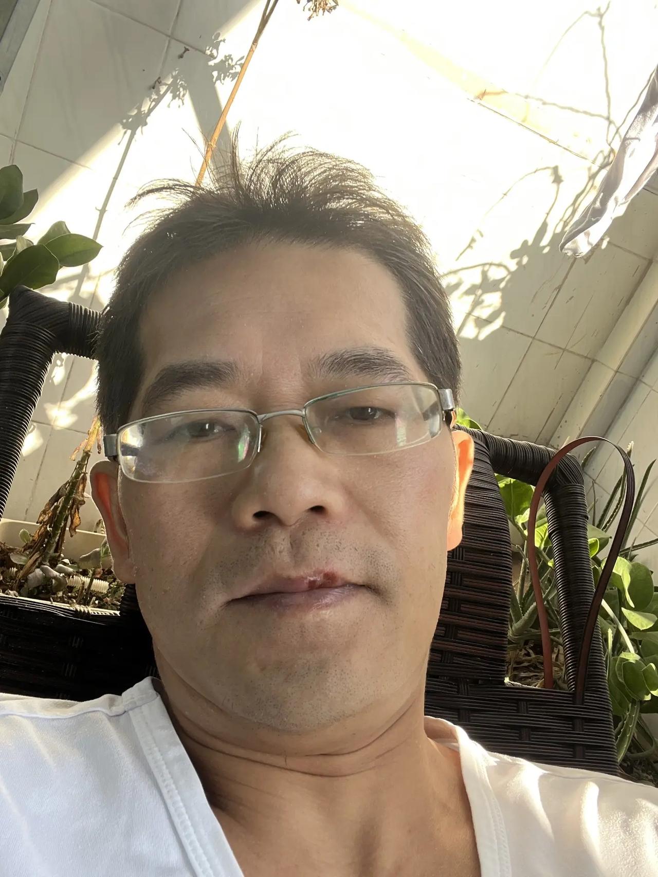 上火了，第一次上火严重！ 生活是一种态度 老了也很帅 日光浴 我的日常生活