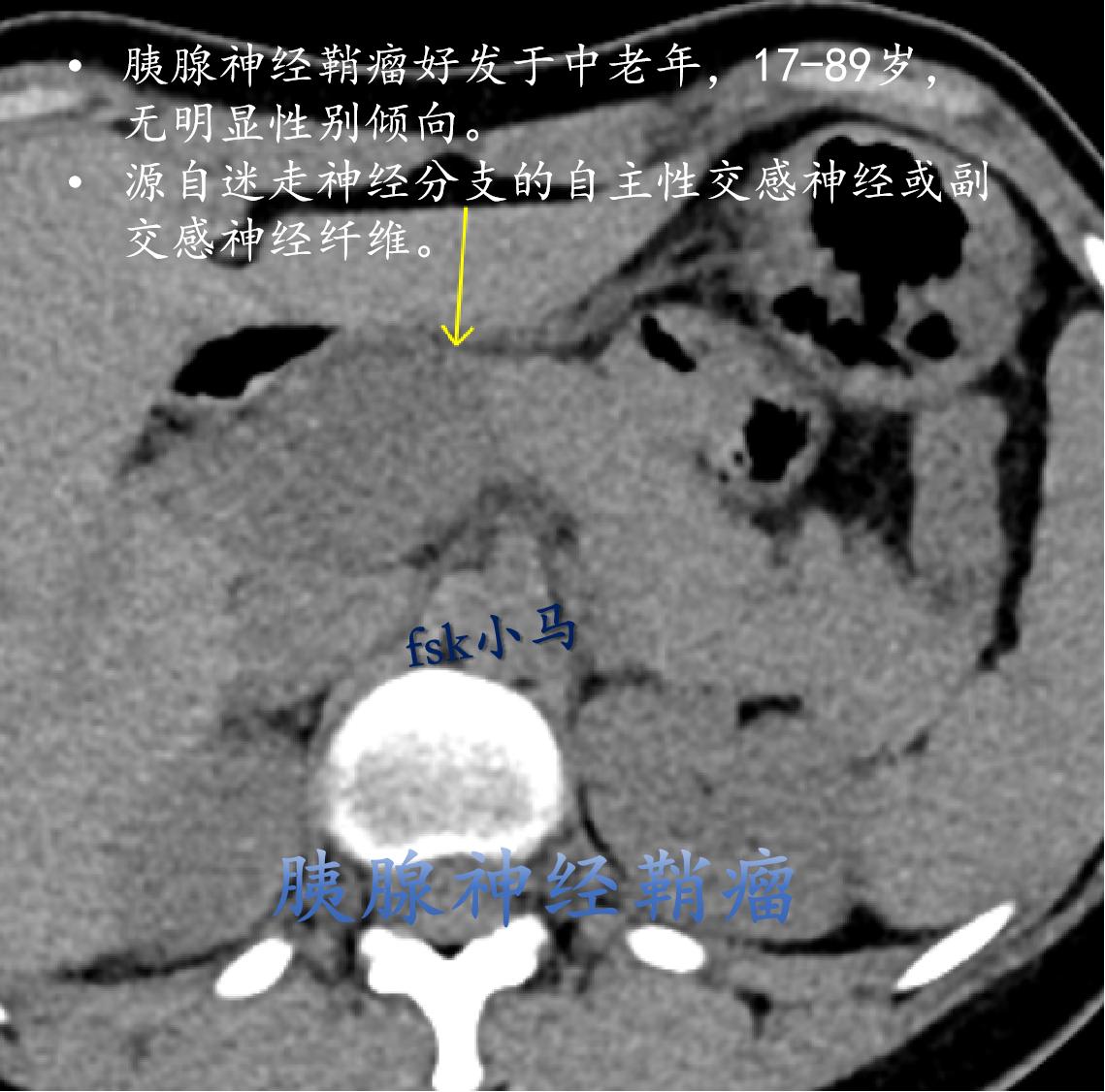 胰腺神经鞘瘤