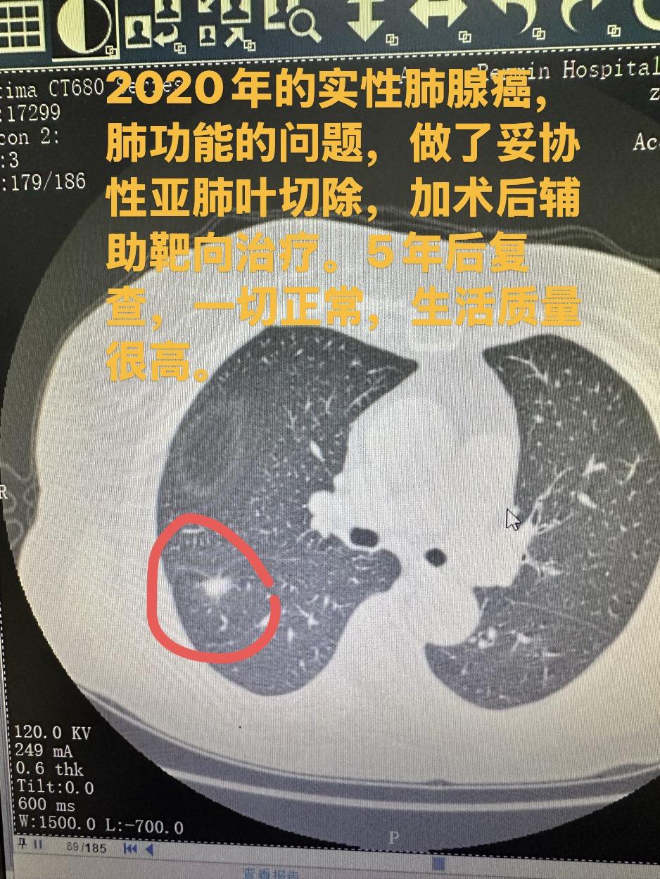 幸运的患者，时间是最好的证明。2020年的实性肺腺癌，肺功能的问题，做...