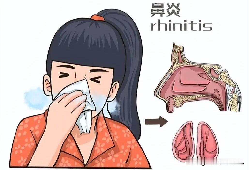 【当心！七成慢性鼻窦炎患者懊悔没早做这4步】
鼻炎、鼻塞、流脓涕，发作时用药压下