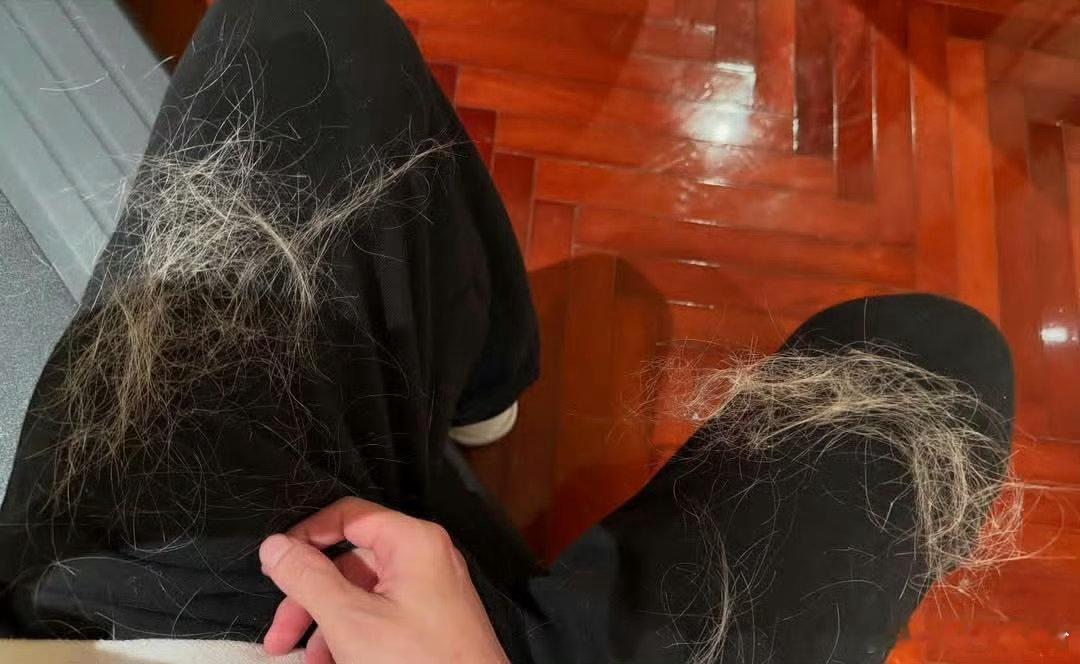 薛之谦满头斑秃和水泡为了舞台完美反复漂染，头皮灼伤起水泡、大片斑秃，硬撑一周不洗