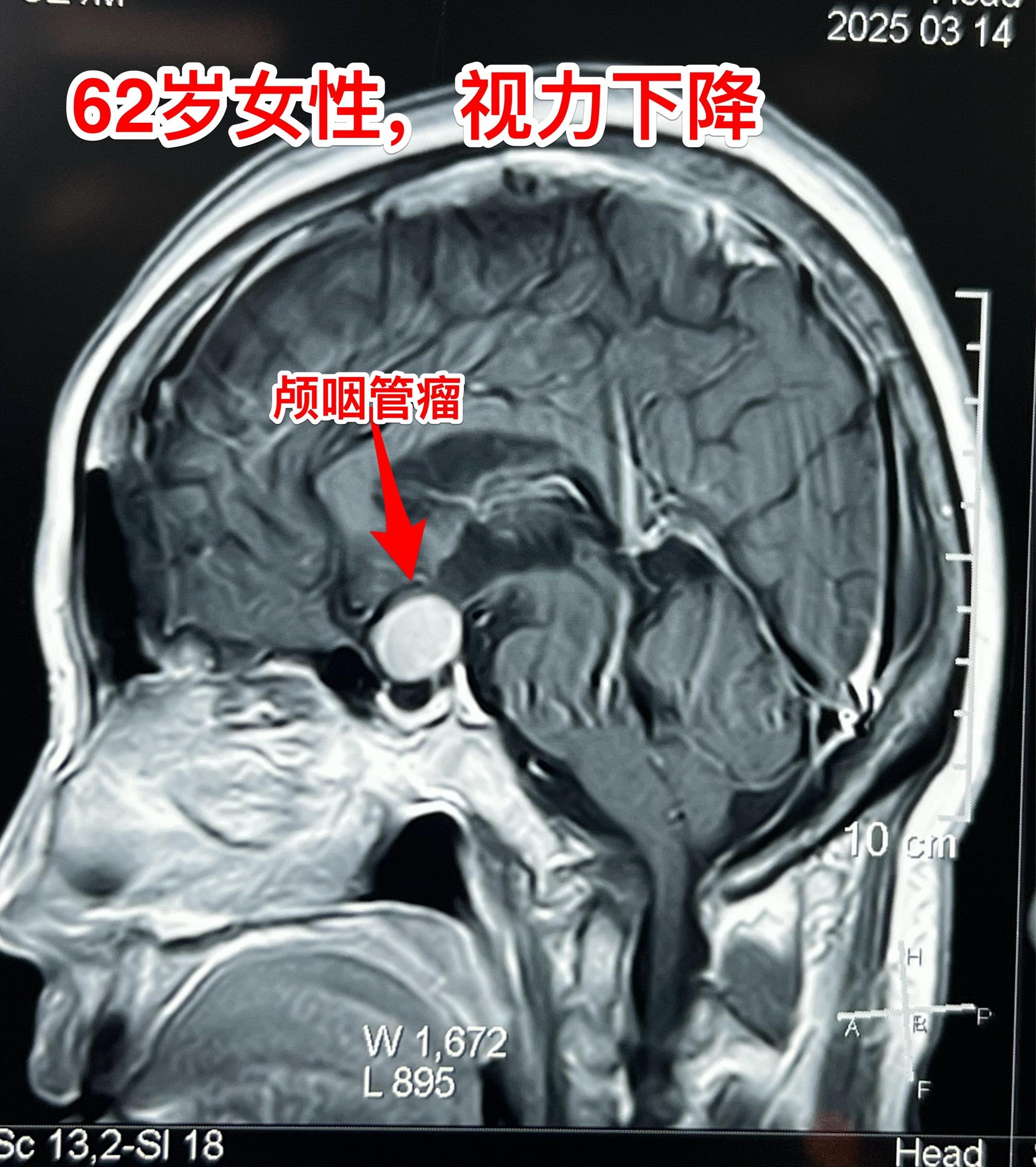 经翼点入路切除颅咽管瘤-不能忘记的入路 经翼点入路切除颅咽管瘤，曾经是...