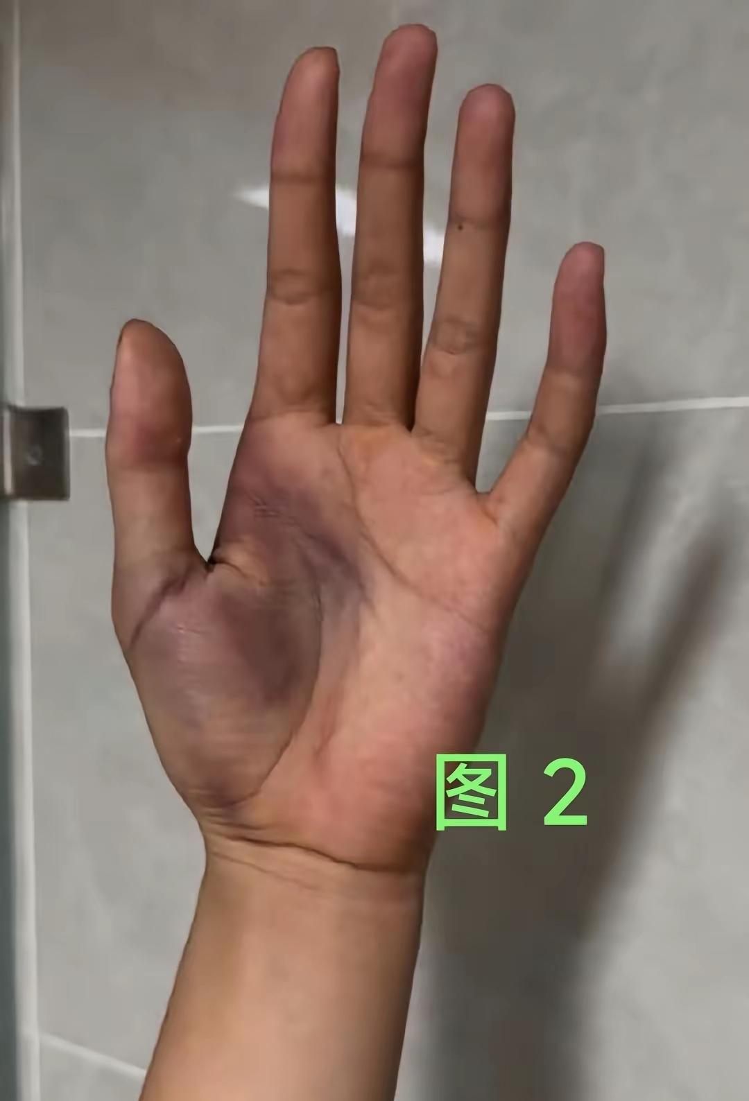手伤成这样还坚持拼下冠军，这就是女排精神。大家在亚运会决赛中可能都看到了9号王奥