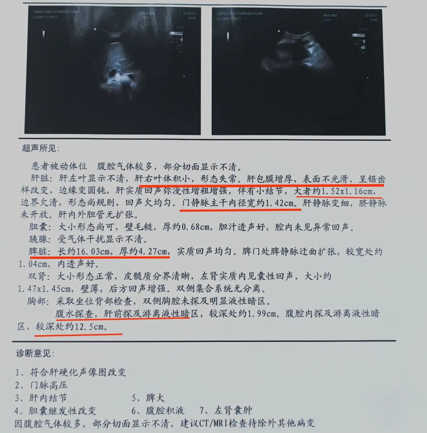 昨天接了一位肝硬化的患者，才46岁，因为有乙肝没治疗导致病情发展到了肝...