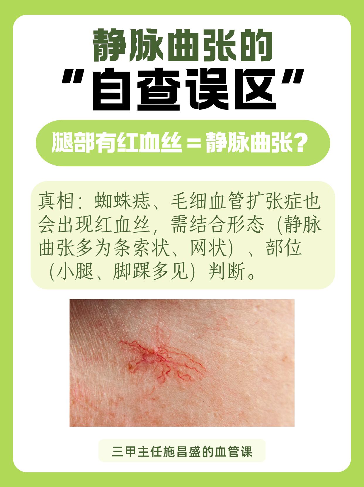 静脉曲张的 “自查误区”。随着人们对自身健康的重视，静脉曲张的自查也逐...