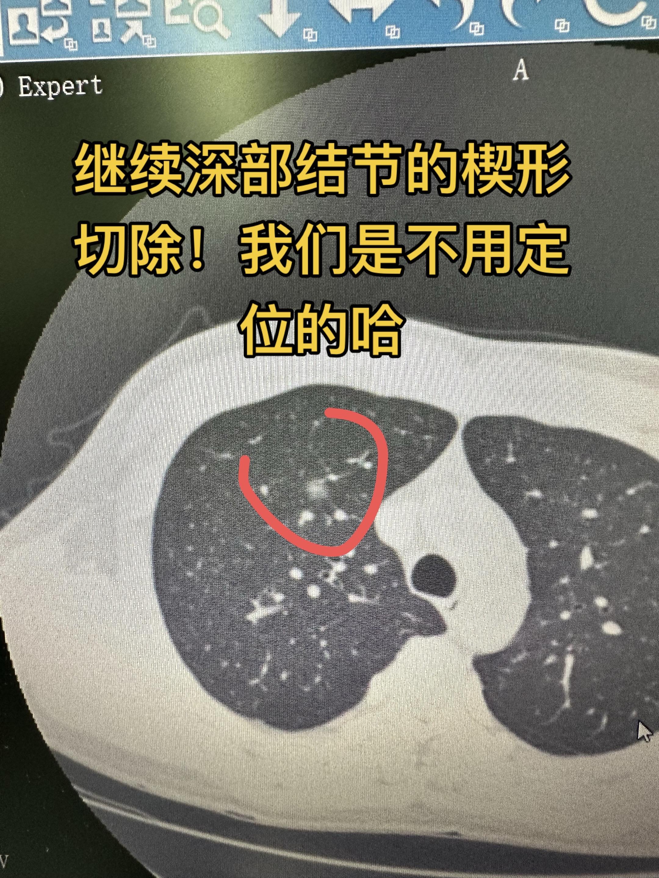 不定位深部结节楔形切除。我们不用术前定位，是用大脑定位。最简便，但是又...
