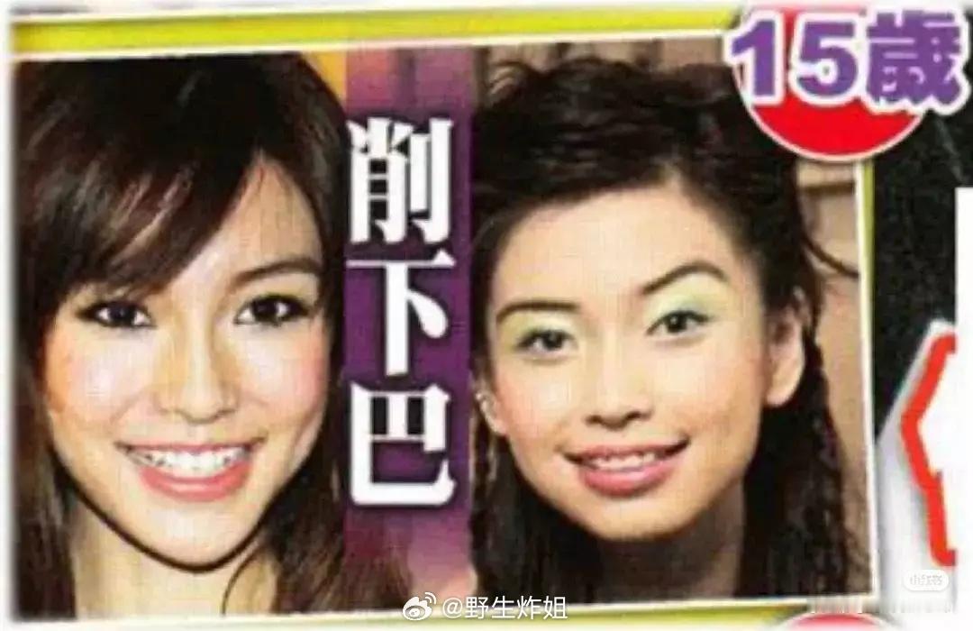 angelababy杨颖是箍了牙齿吗 ​​​