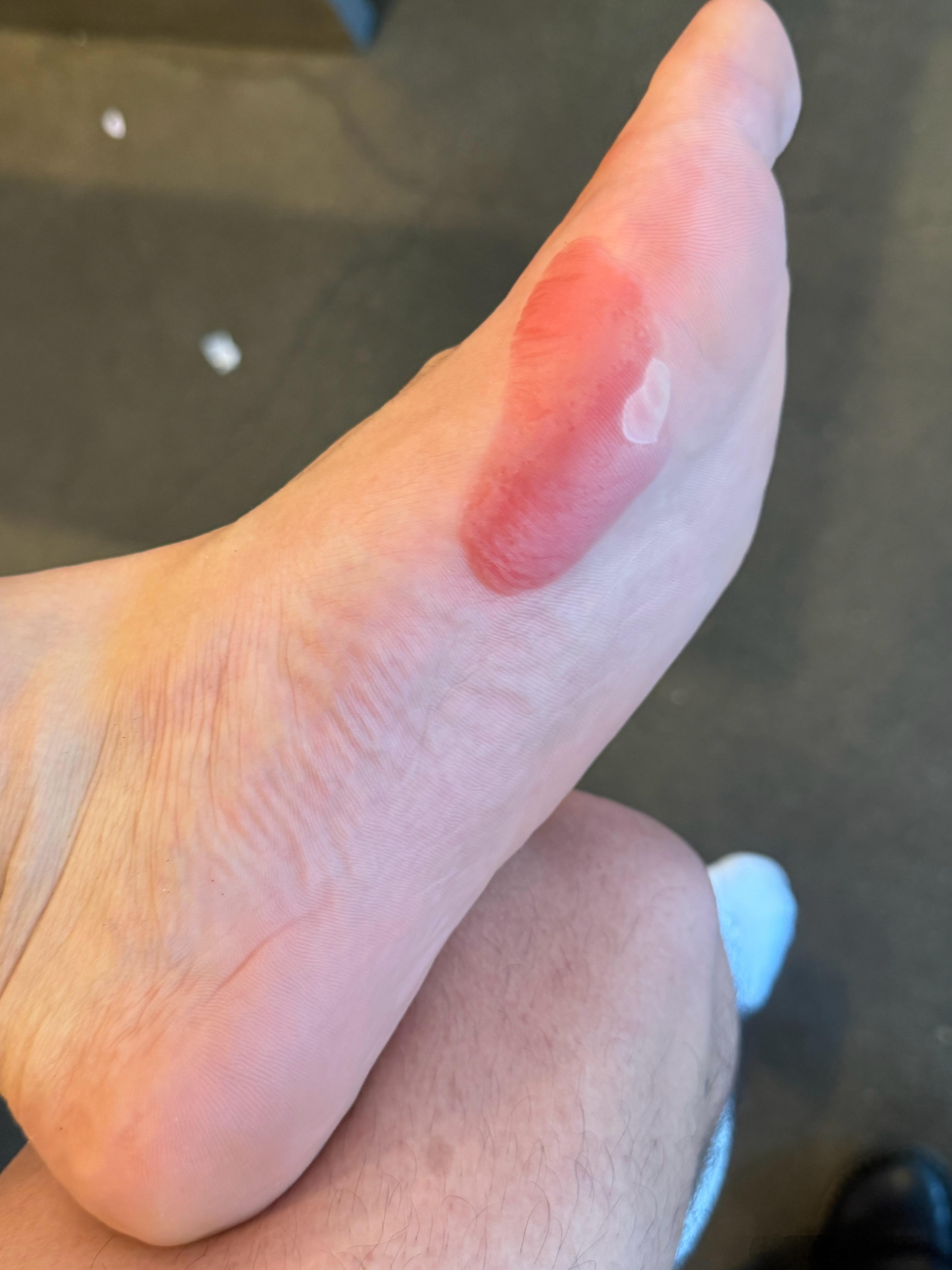 前天小同学发短信说太想跑步了，我阻止他，至少要等到脚上的大血泡好了再跑。刚才一早