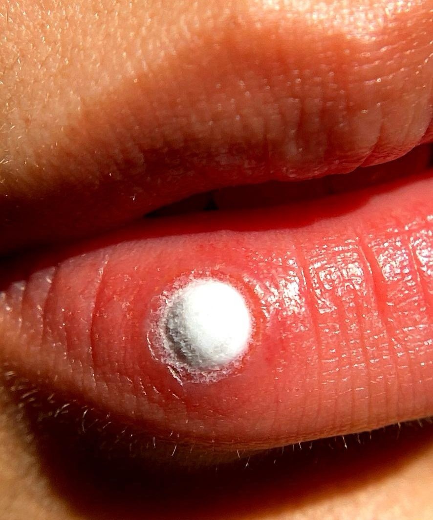 昨晚多年未见的发小来家里吃饭，酒过三巡，我忽然瞥见他左下唇有个黄豆大的白圈，看着