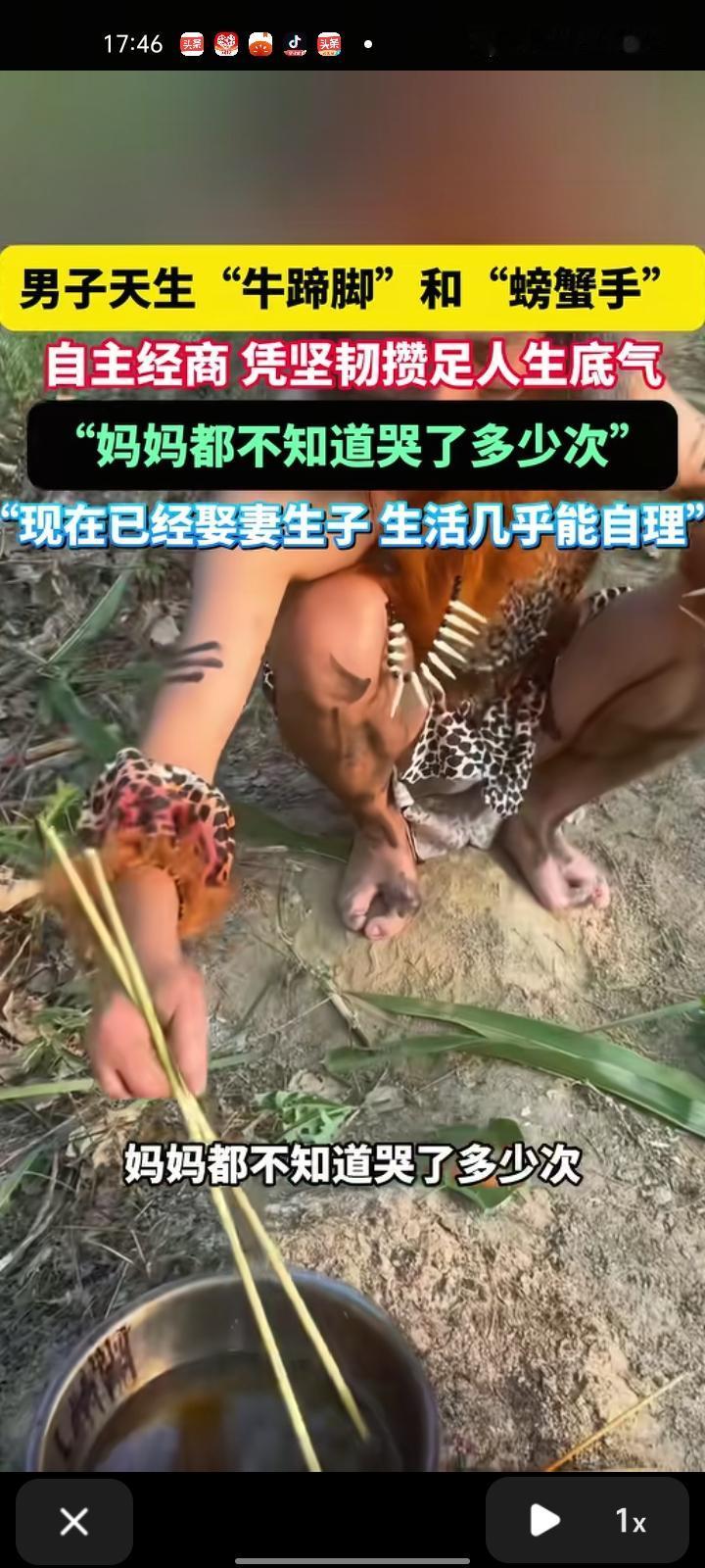 12月10日，亳州市利辛县。男子天生带“牛蹄脚”和“螃蟹手”，不影响正常生活，除