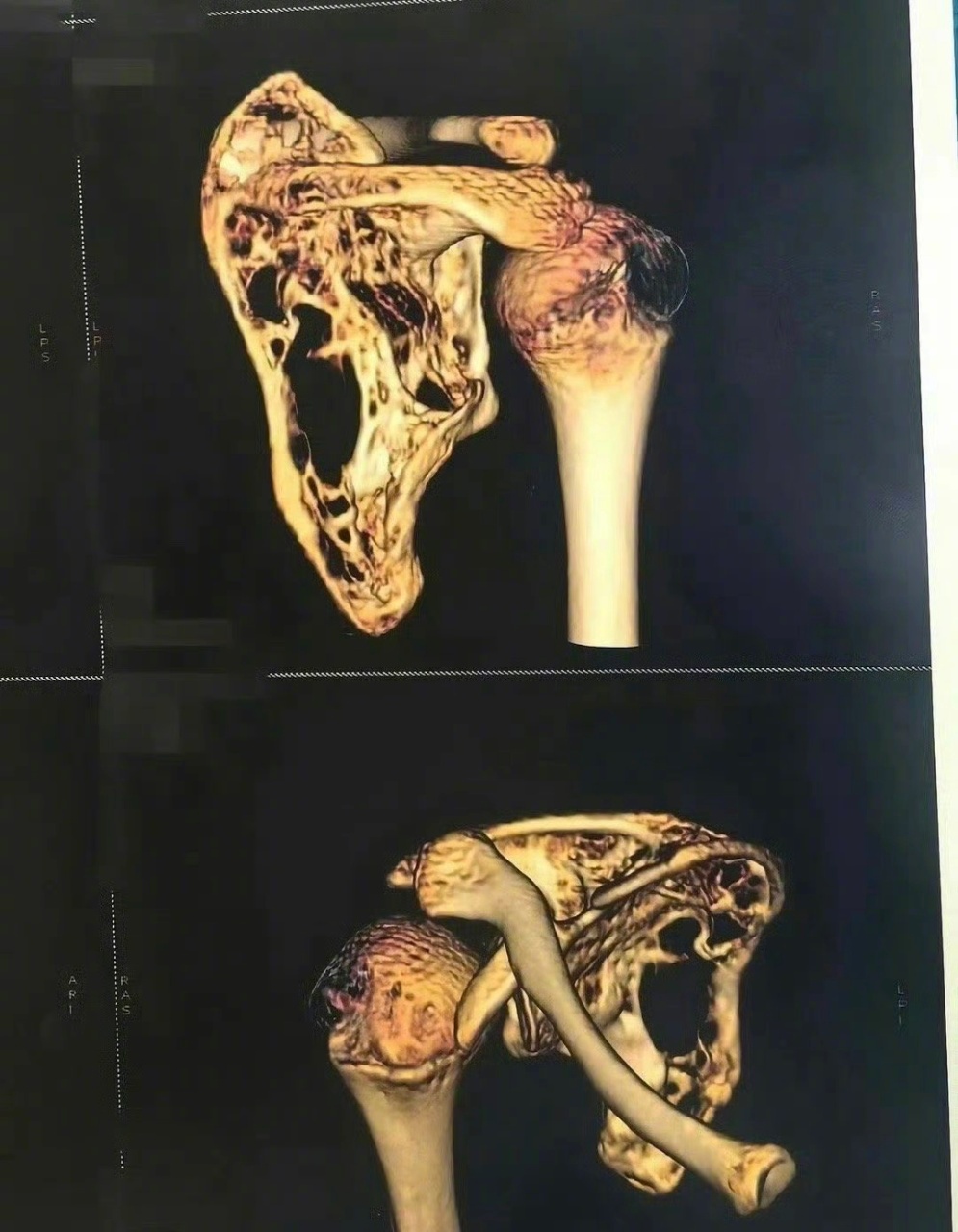 #11年4次手术失败女孩再迎希望手术# 河北邯郸女孩小彤，11年前摔伤骨折后骨骼