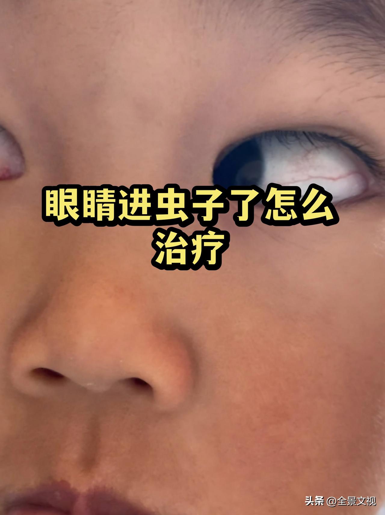 昨天下午在西安文景公园练琴，六点起身要走的时候一只小飞虫钻进我右眼，当时就无法睁