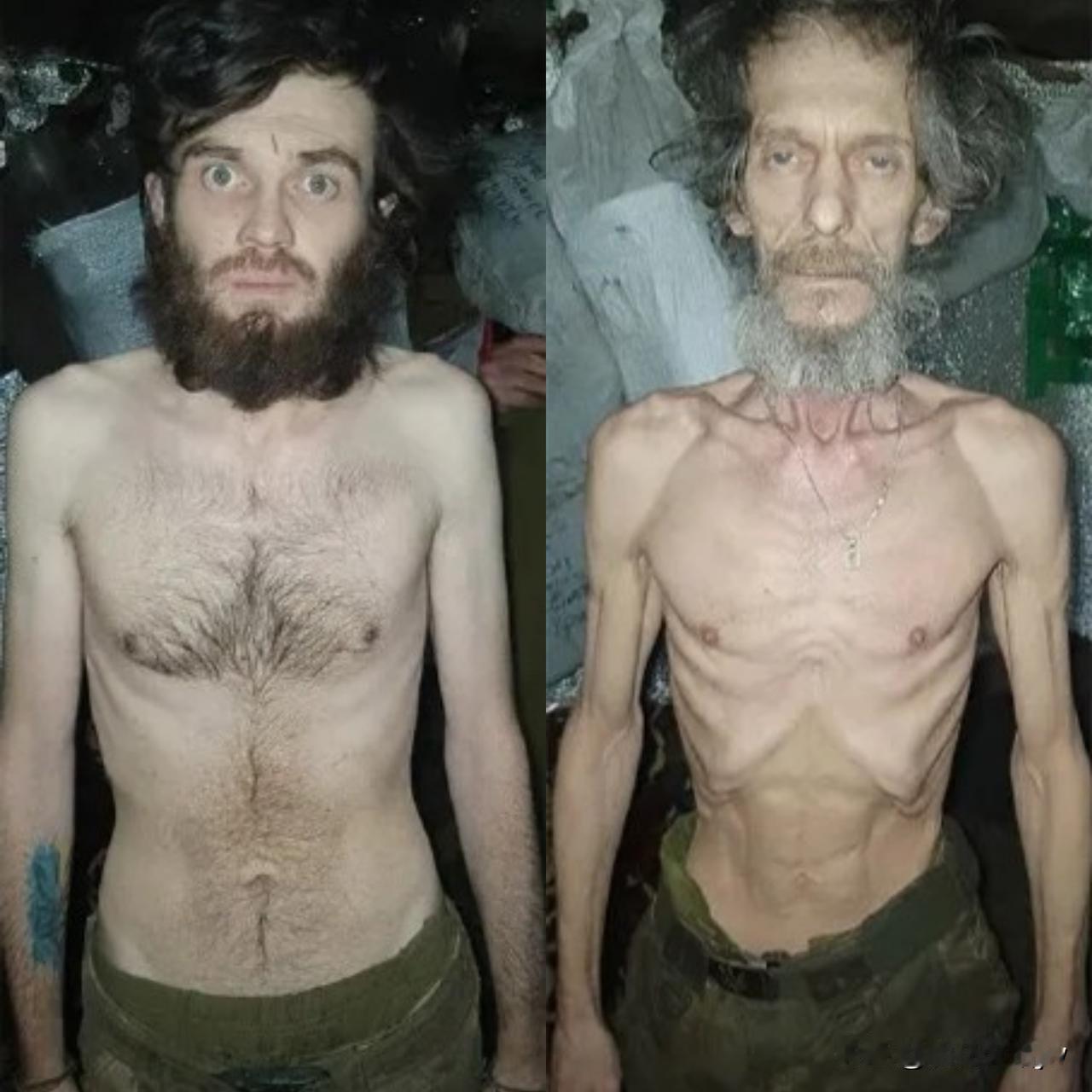 照片中，这名乌军士兵面色苍白、营养不 良特征明显，肋骨突出、四肢枯瘦。

乌军已