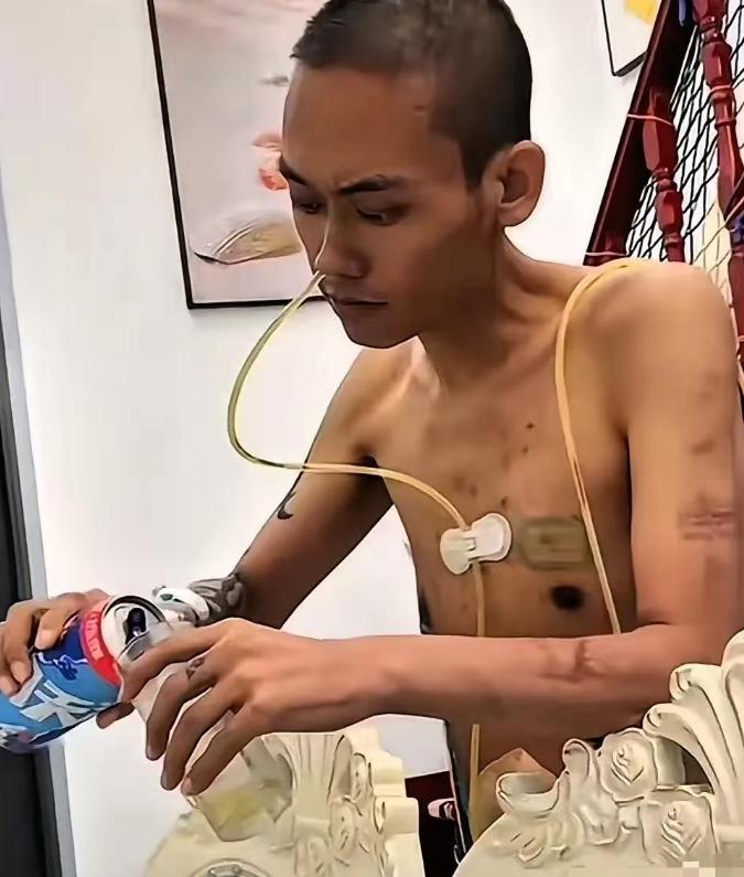 2023年，有个肝癌晚期的男子，放弃治疗后买了箱啤酒。他光着膀子插着管子，对着啤
