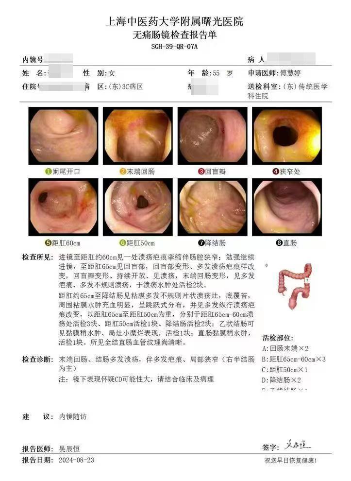 拖了3年的克罗恩病，1年重获新生！  这位患者在21年由于没有重视肠病...