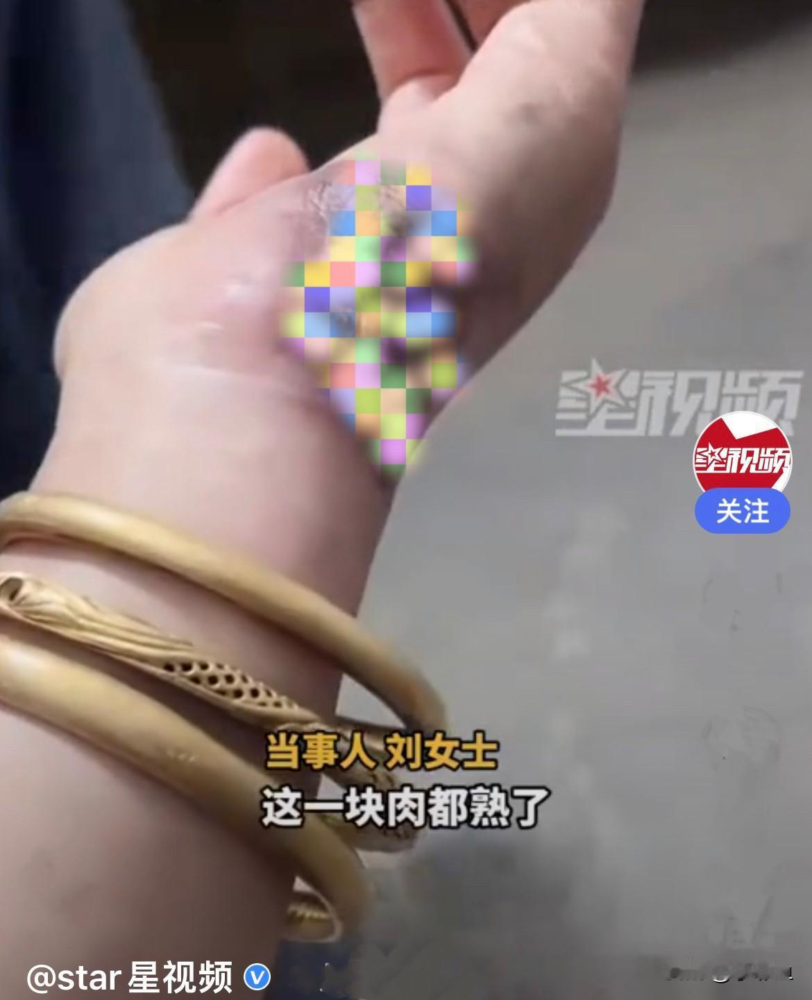 安徽宿州一名女子在给电动车充电时，不小心触到充电口，导致手部被严重电伤，佩戴的3