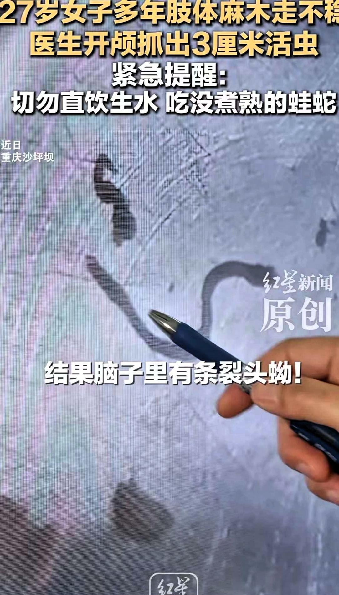 重庆一女子，头疼了5年。
跑遍大医院，医生都说可能是脑瘤。
结果开颅后，取出来的