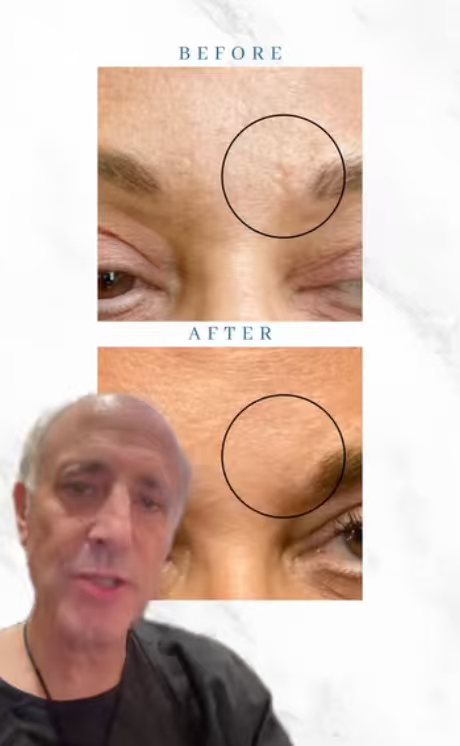 趁着肉毒失效了写一个科普贴，你们看我眉心的这些纹路就是很明显的动态纹，这个动态纹