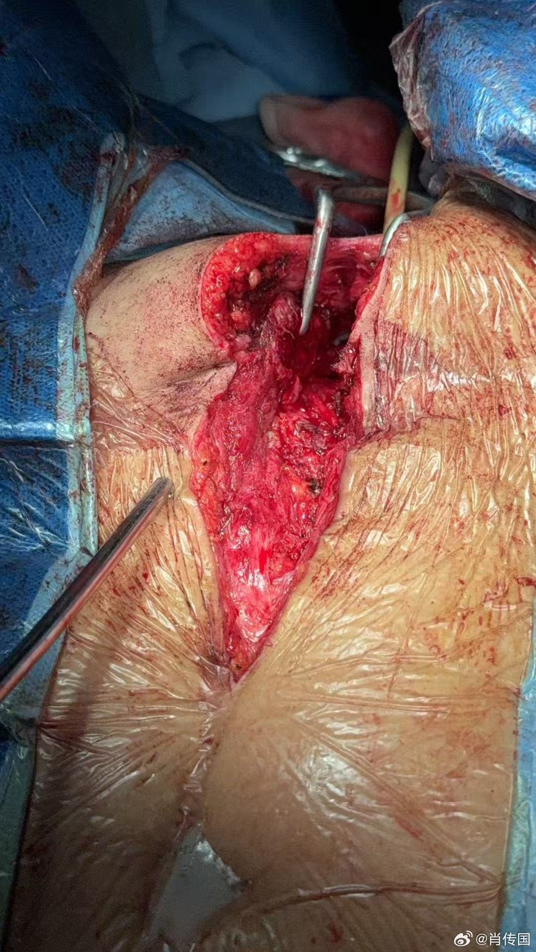 我因肖氏反射弧神经泌尿外科出名，但我的专业实际是整形泌尿外科，作为美国泌尿外科学