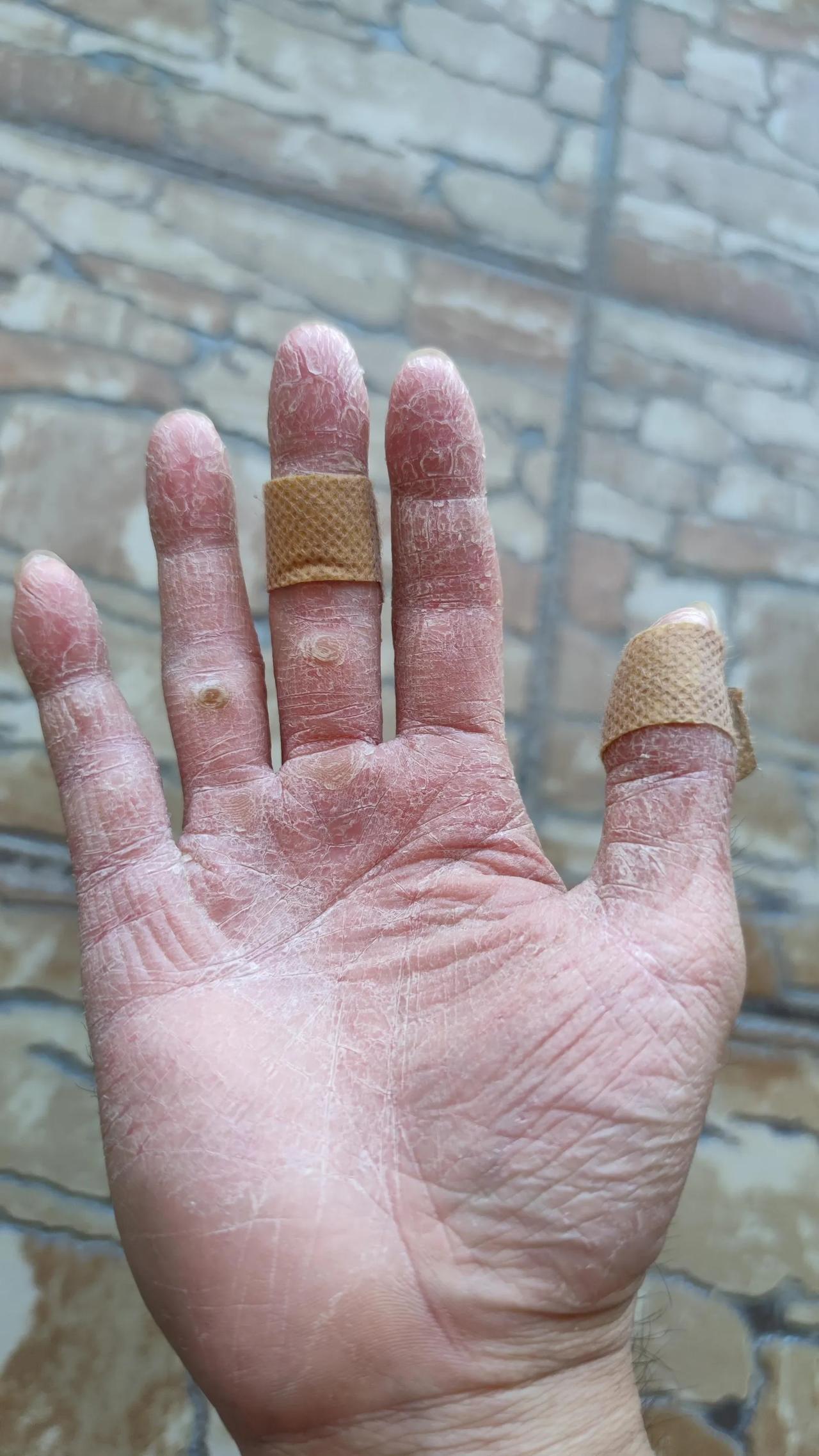 手干裂的严重，这到底是为什么。从去年一直到现在，没好过，涂过各种东西，吃过各种维