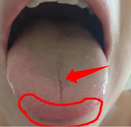 男同志最怕在最关键的时候不行，这样的舌苔，欲望虽强但是实战很差！
看图中的舌苔有