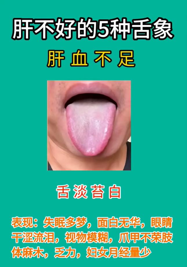 肝火、肝血不足，五种肝系舌象一次分清