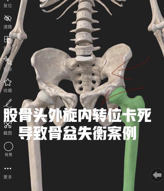 股骨头外旋内转位卡死