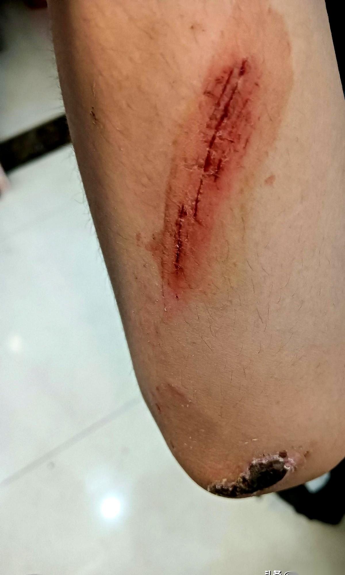 儿子独自躲在角落涂碘伏，瓶盖拧开的声响，在安静的客厅里格外刺耳。
我低头瞥了眼自