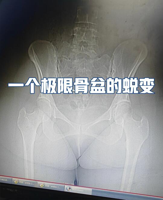 一个极限骨盆的蜕变