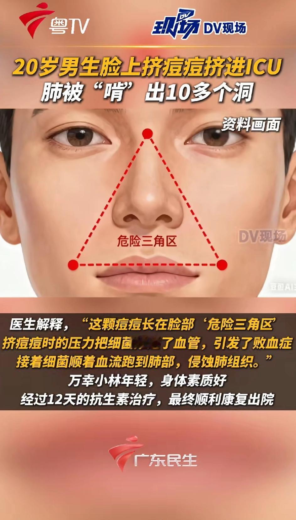 20岁男子挤痘痘挤进ICU肺被“啃”出10多个洞，这事儿听起来太吓人了。男生小林