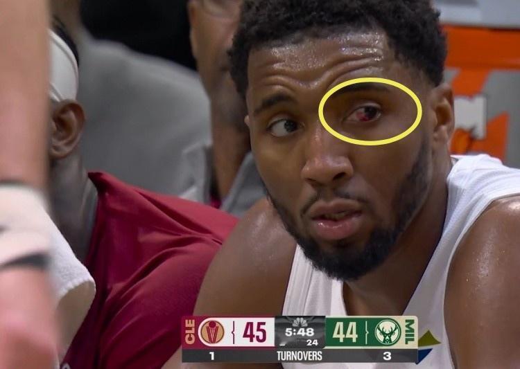 谈到自己被打到充血的眼睛，骑士米切尔说：“我的左眼几乎看不见了，今晚很艰难！”