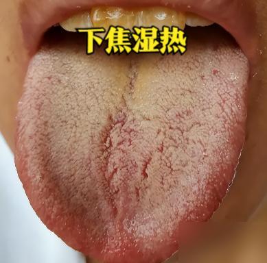湿热才是男人最大的公敌，房事越来越差，根源全在体内这团湿浊热毒！

说真的我前两