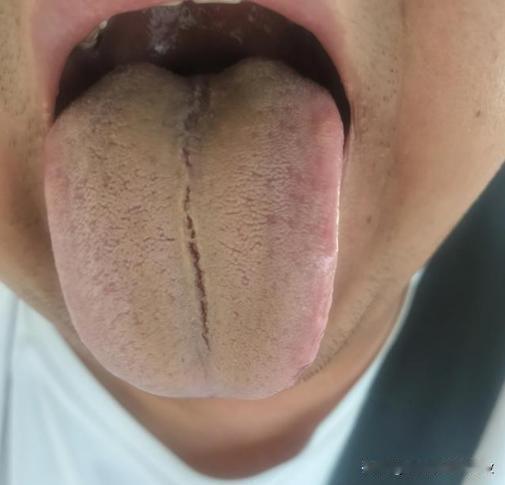 头疼啊，为啥一个个年纪轻轻的，一身毛病[发怒][发怒][发怒]
主诉：阴囊潮湿，