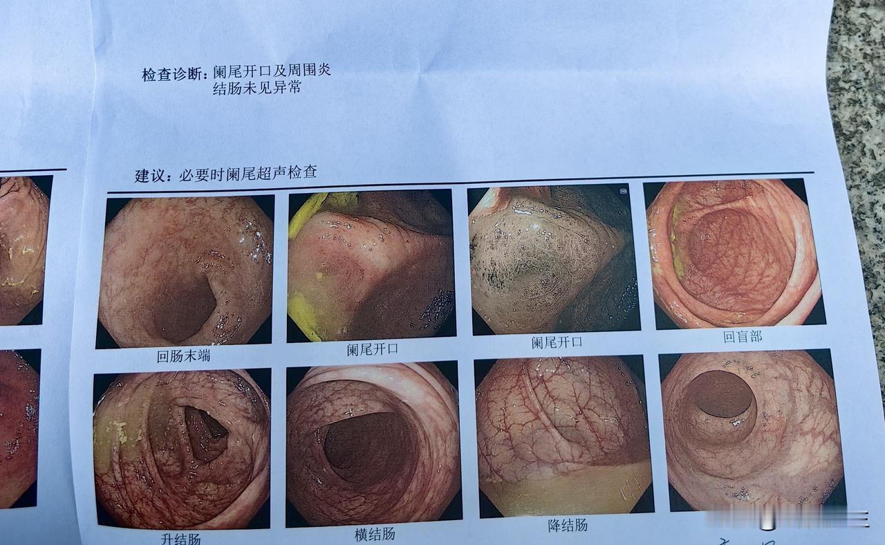 胃肠镜检查。最近几年周围议论，网络推送全是胃肠镜早筛查，早受益，加之自己有几项符