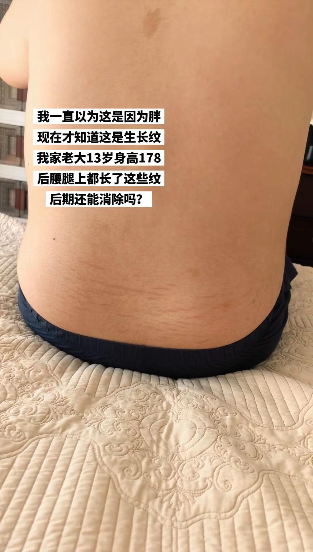 孩子身上长的生长纹会消失吗？不会和妊娠纹一样跟着一辈子吧😓😓