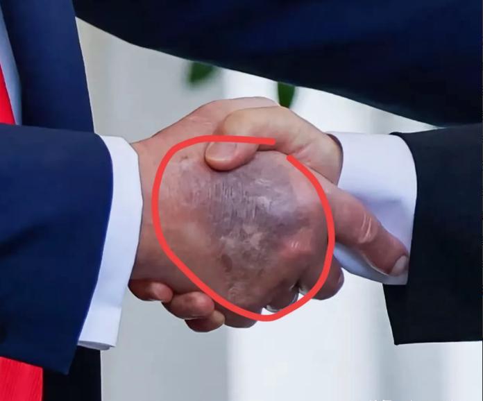 特朗普在白宫会见李在明，被记者拍到手背乌黑淤青，最初面积小时还涂遮瑕膏，现在面积