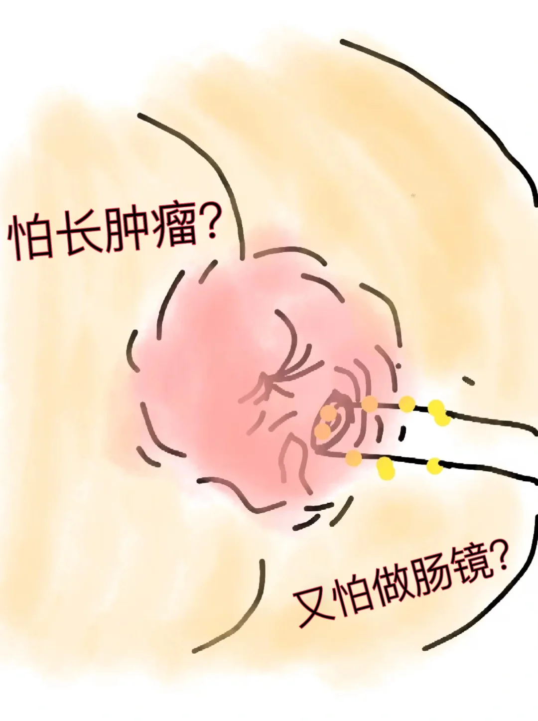 怕肠道肿瘤？又怕做肠镜？