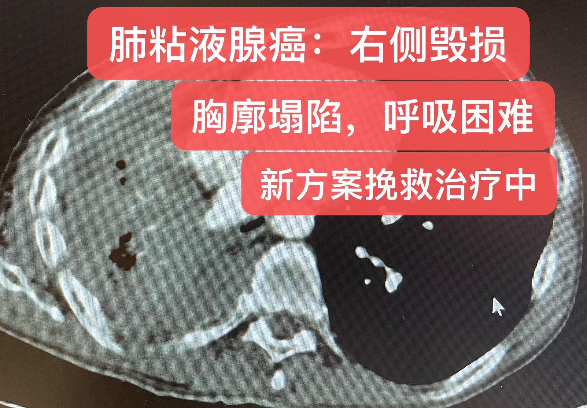 肺癌：粘液腺癌晚期的挽救治疗。肺粘液腺癌，广泛转移，基因检测阴性，既往...