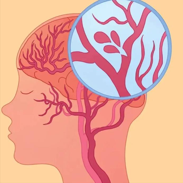 脑梗分级：绿灯能救，黄灯要抢，红灯最凶险！

同样是脑梗，有人出院后照样上班，有