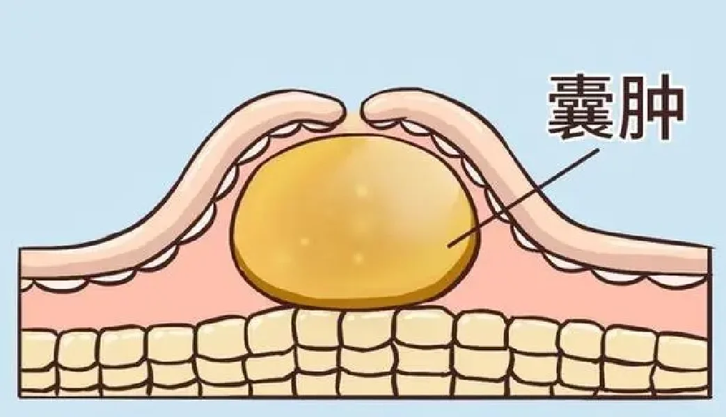 淋巴管囊肿是一种淋巴管的良性过度增生。 大多为先天性的，少部分为后天形...