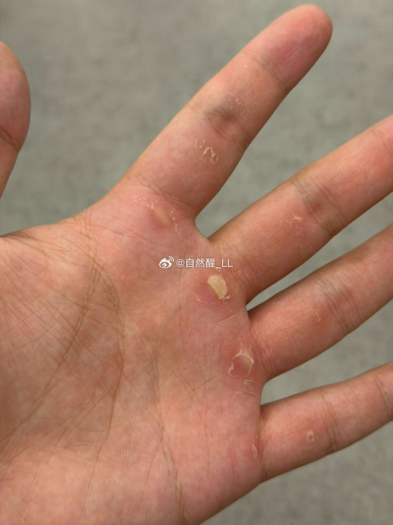 练到外翻 
