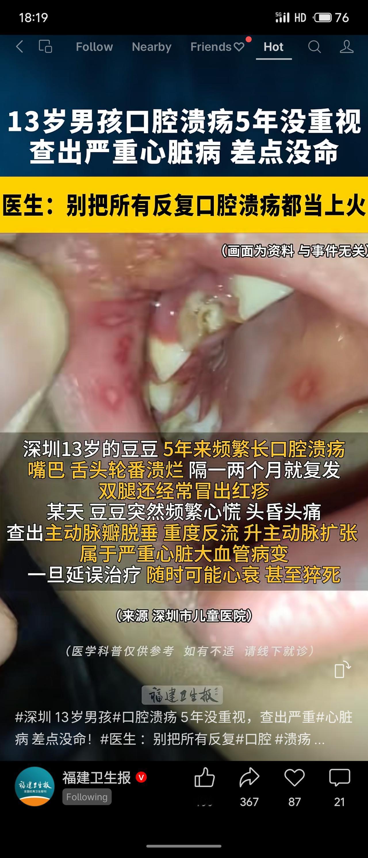 深圳13岁男孩反复口腔溃疡5年，误当“上火”，最终确诊白塞病，引发主动脉瓣重度反