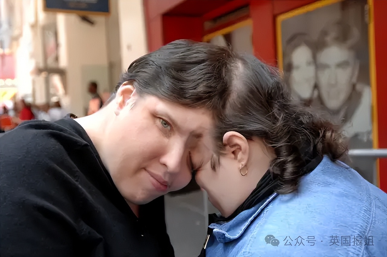 世界最老连体双胞胎姐妹变兄妹！姐姐公开变性，称瞒了妹妹46年？