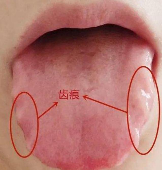 也就10天，两个中成药，“齿状痕”就找不到了！

患者主诉：经常心烦失眠，控制不