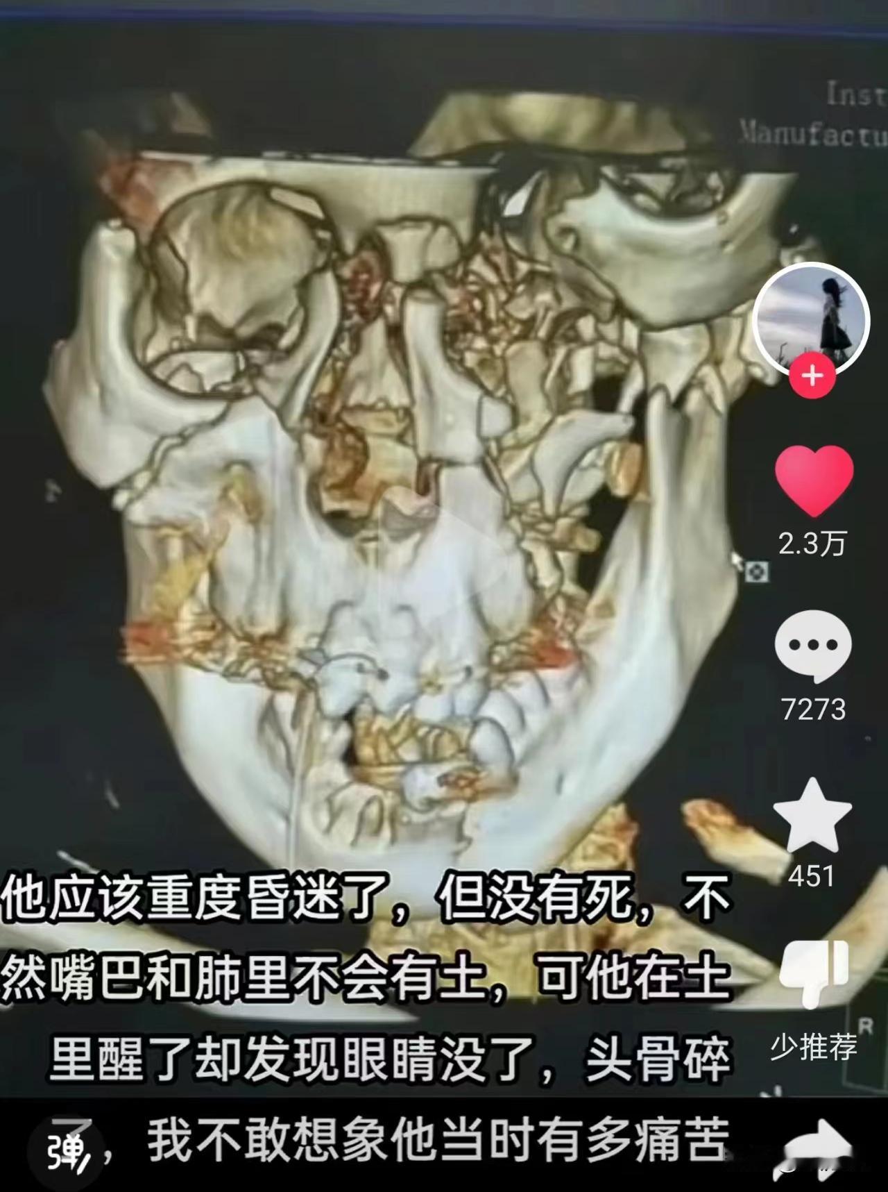 如果小光还活着大家，如果埋的浅一点，如果他爬出来了，说不定大家一同捐款，他还可以